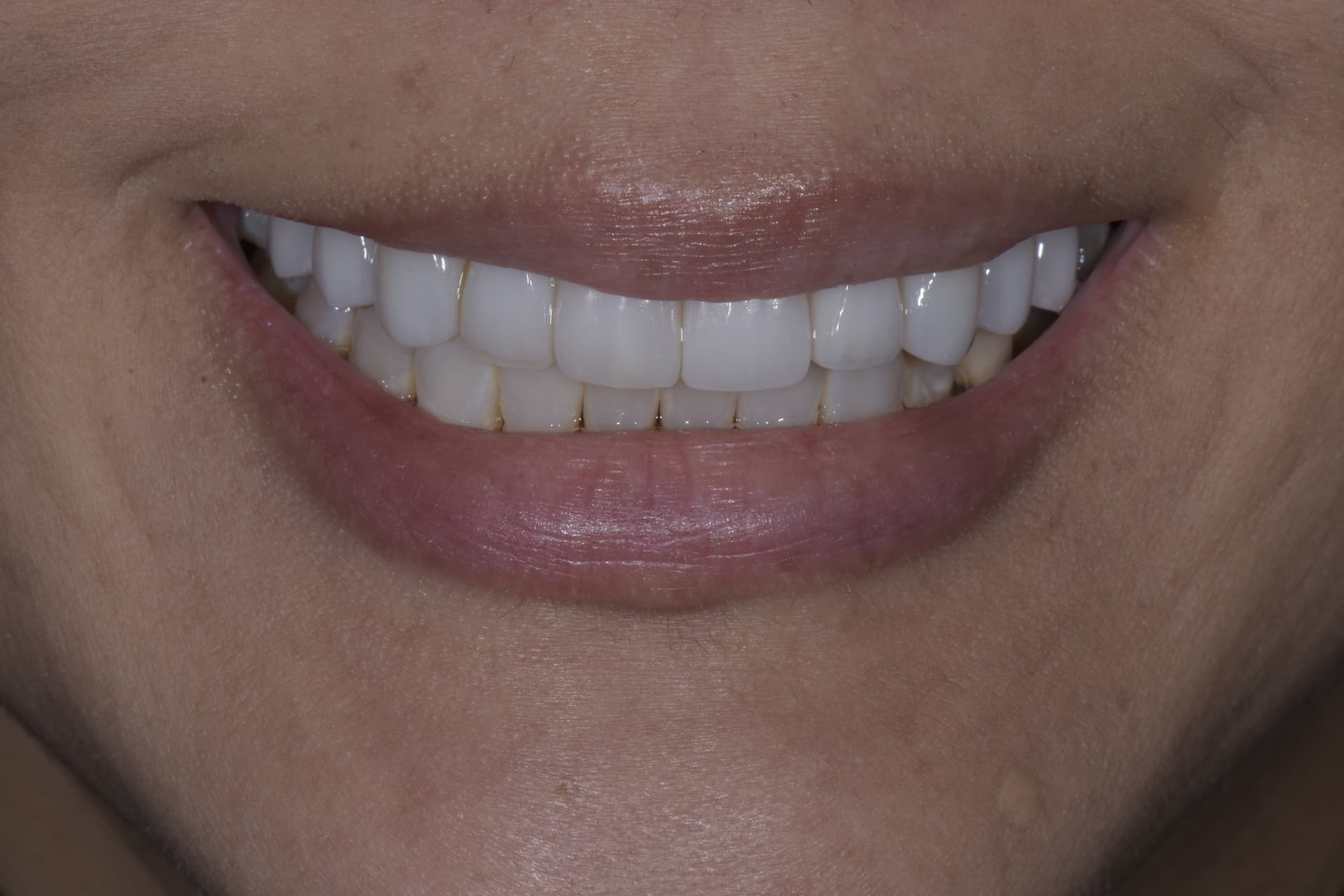 Smile after veneers, patient 2