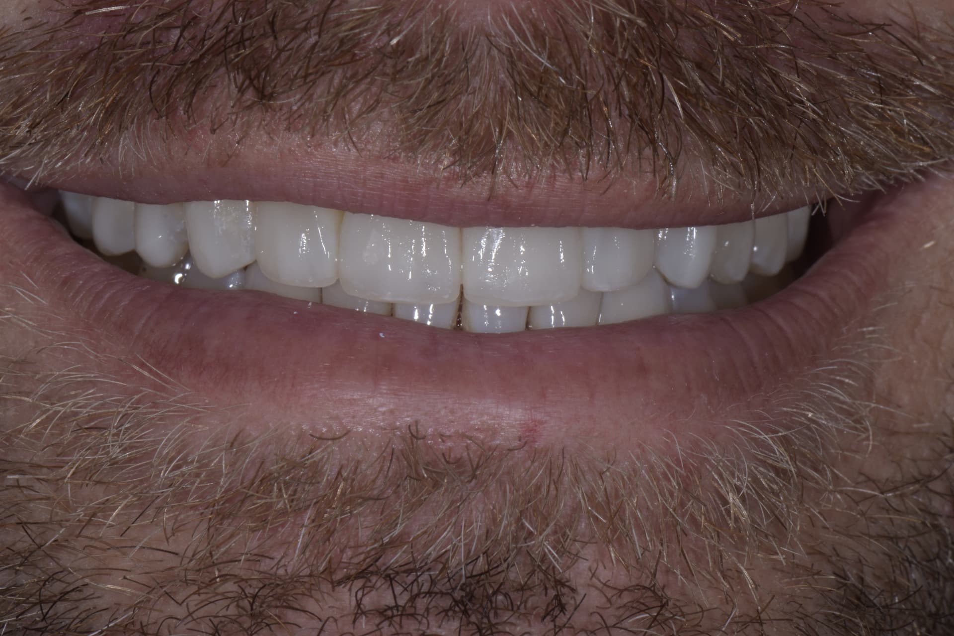Smile after veneers, patient 4