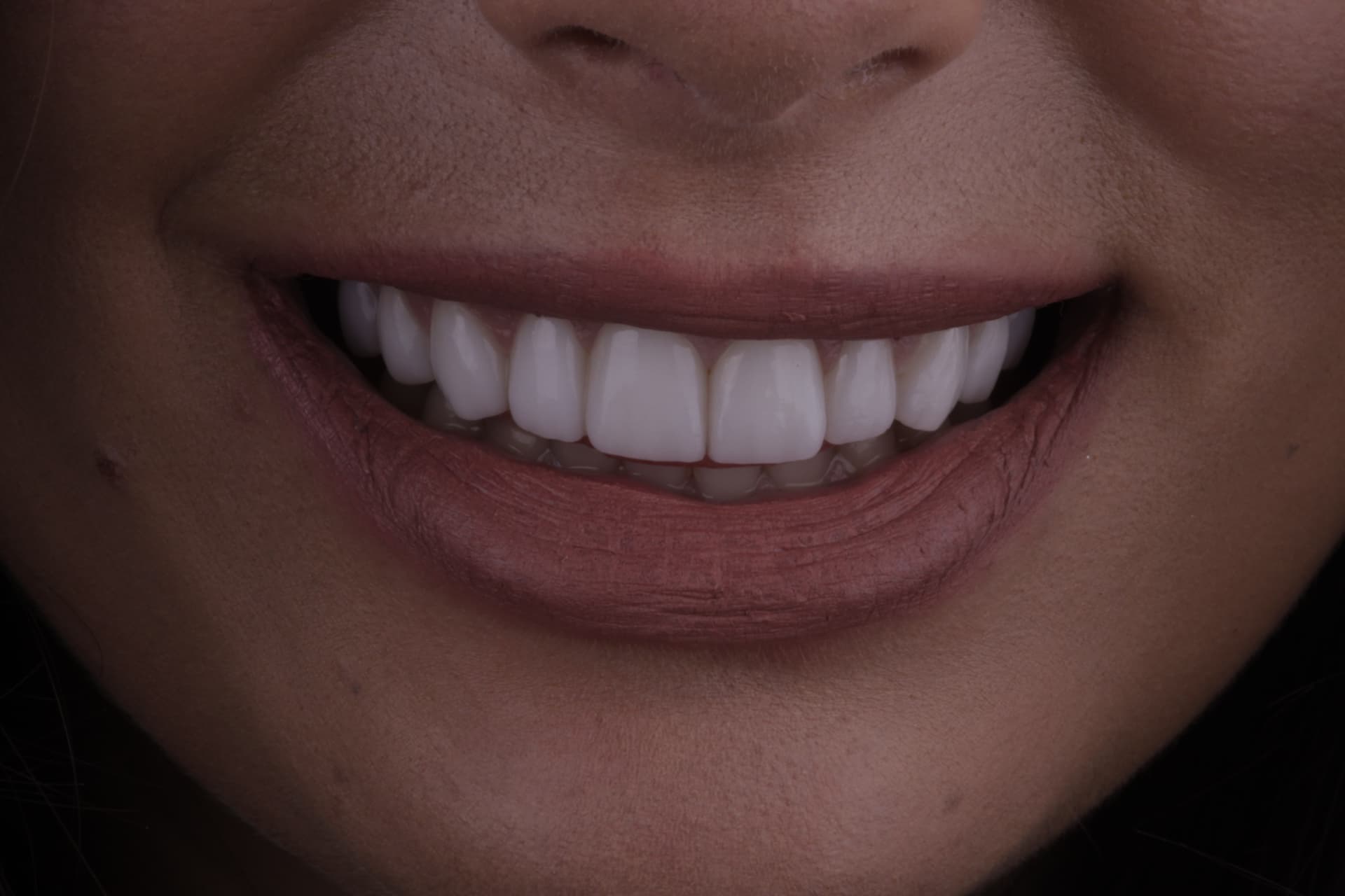 Smile after veneers, patient 5