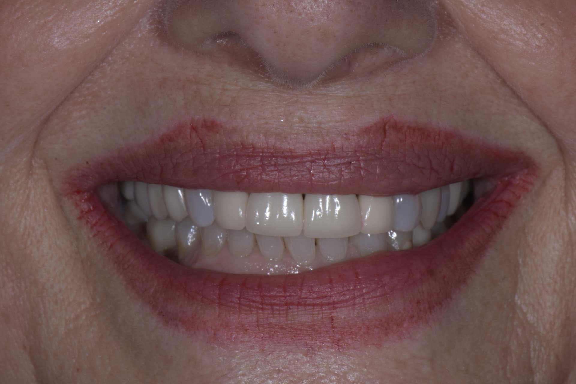 Smile before veneers, patient 1
