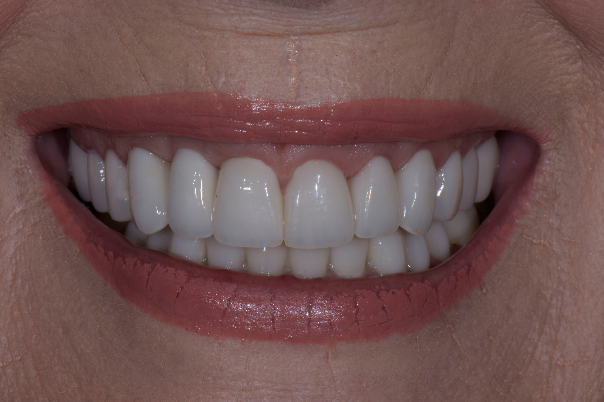 Smile after veneers, patient 6