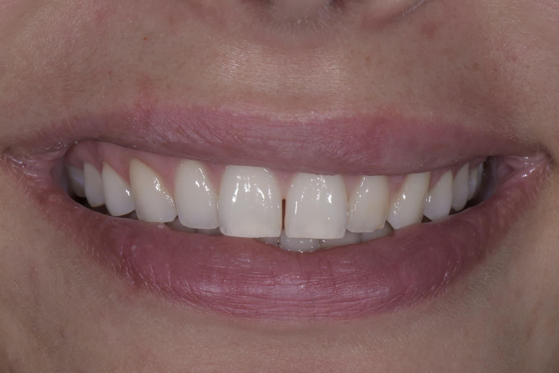 Smile before veneers, patient 5
