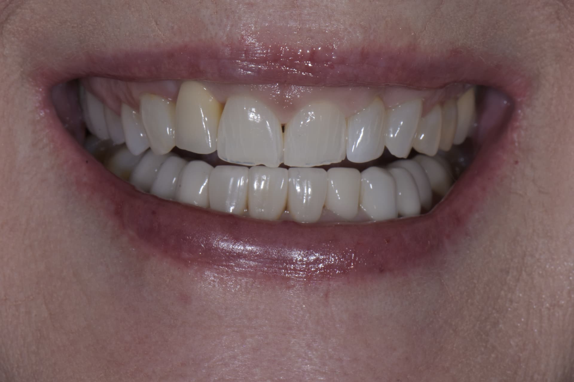 Smile before veneers, patient 6