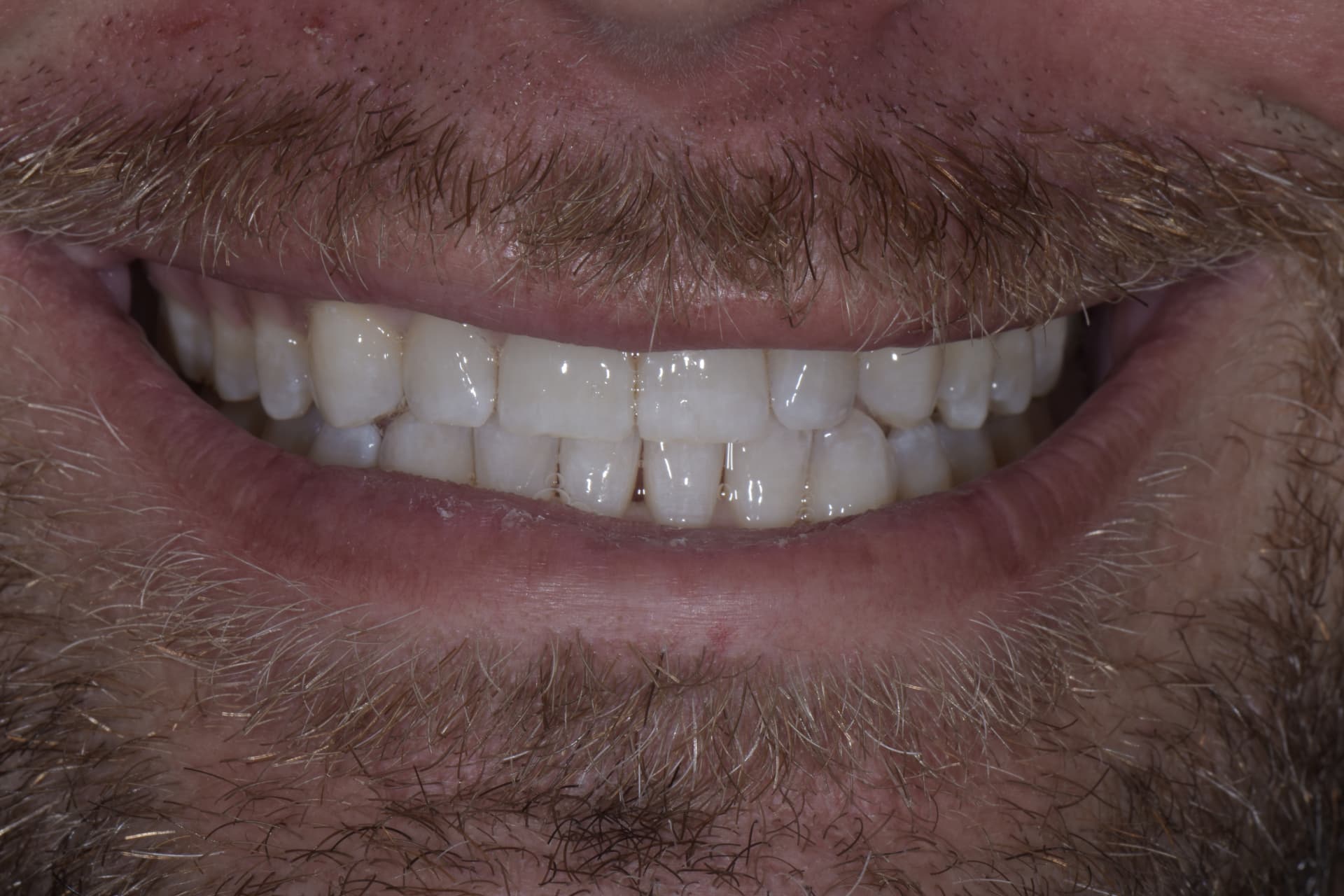 Smile before veneers, patient 4