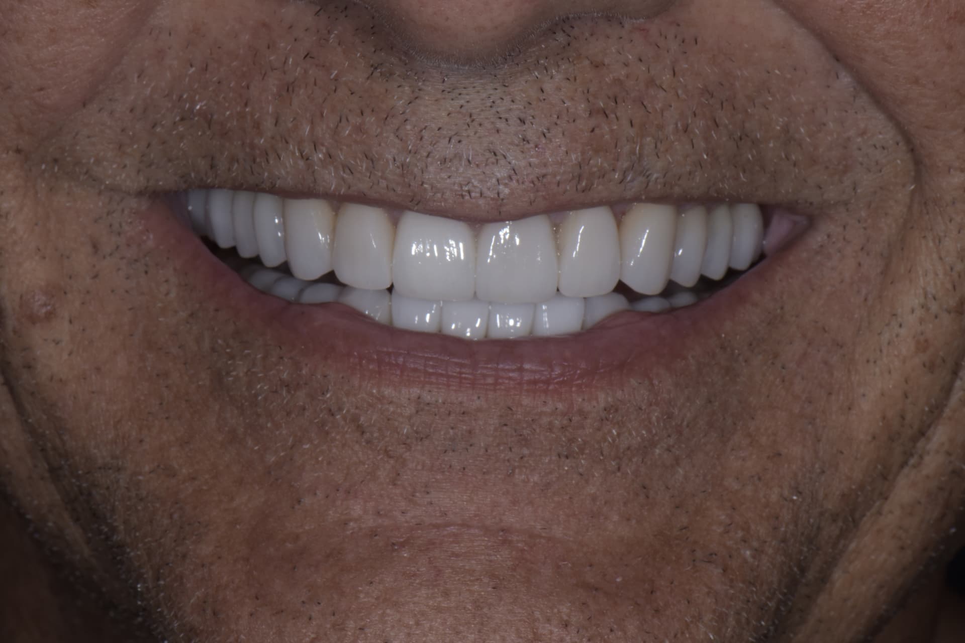 Smile after veneers, patient 3