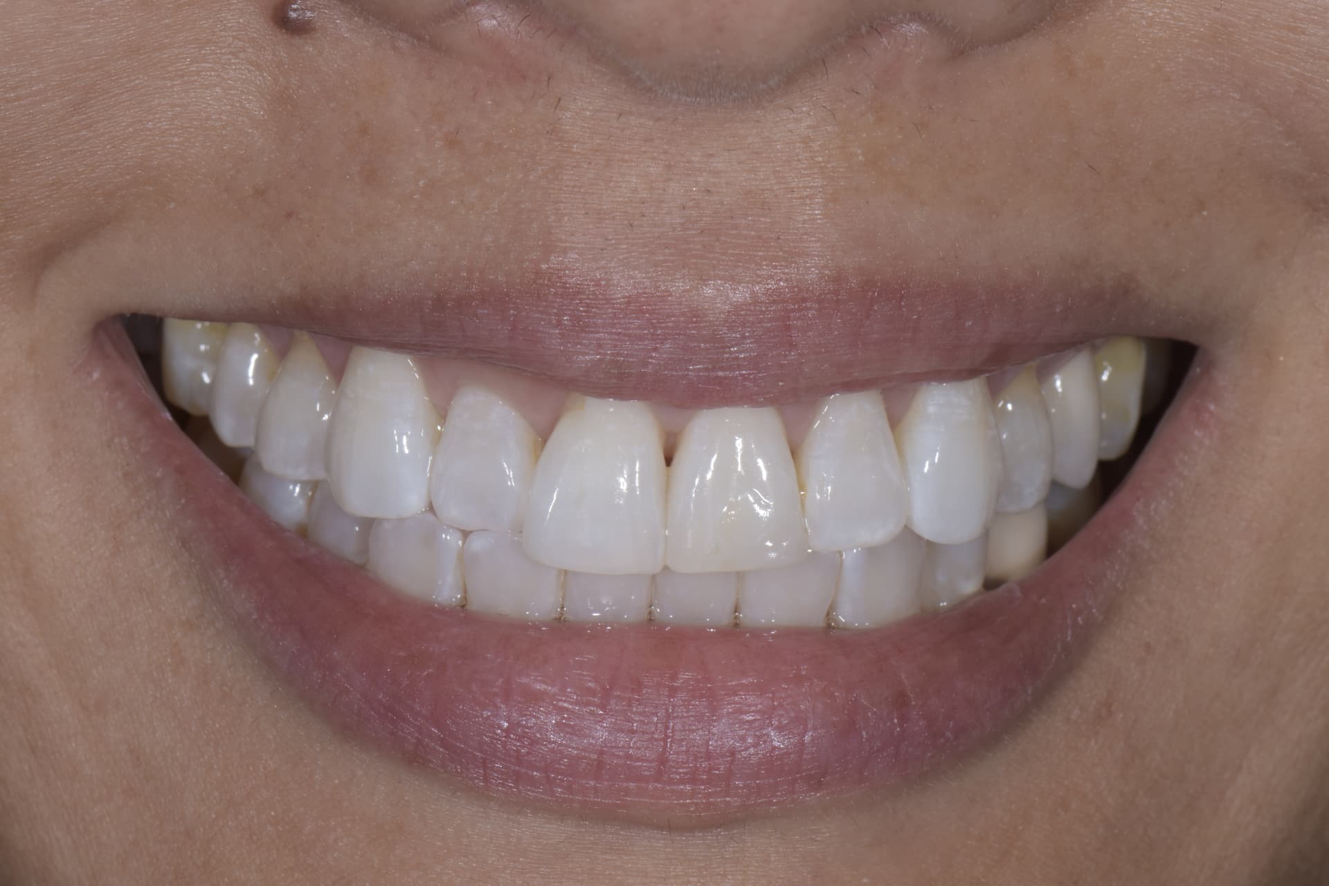 Smile before veneers, patient 2