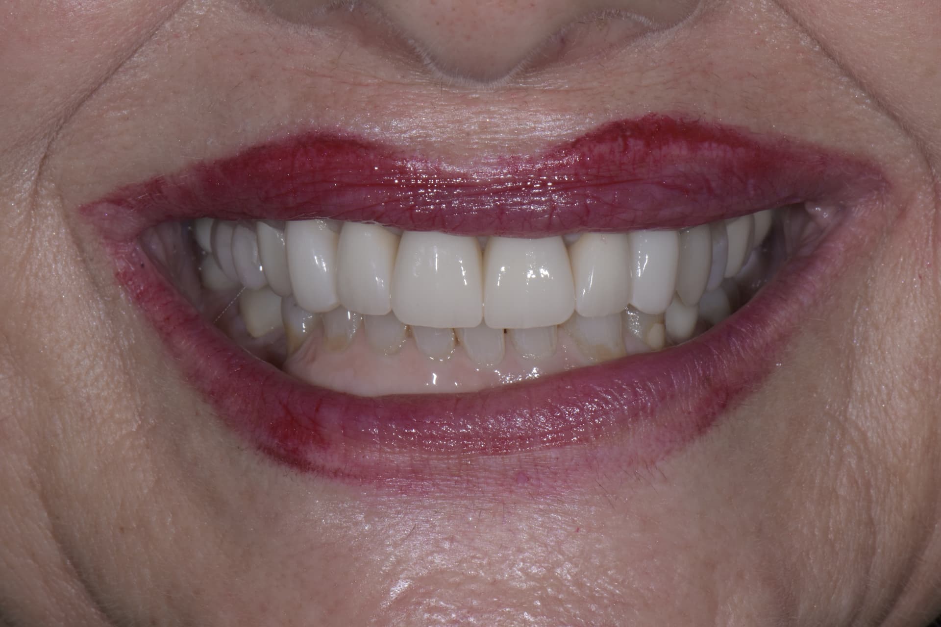 Smile after veneers, patient 1