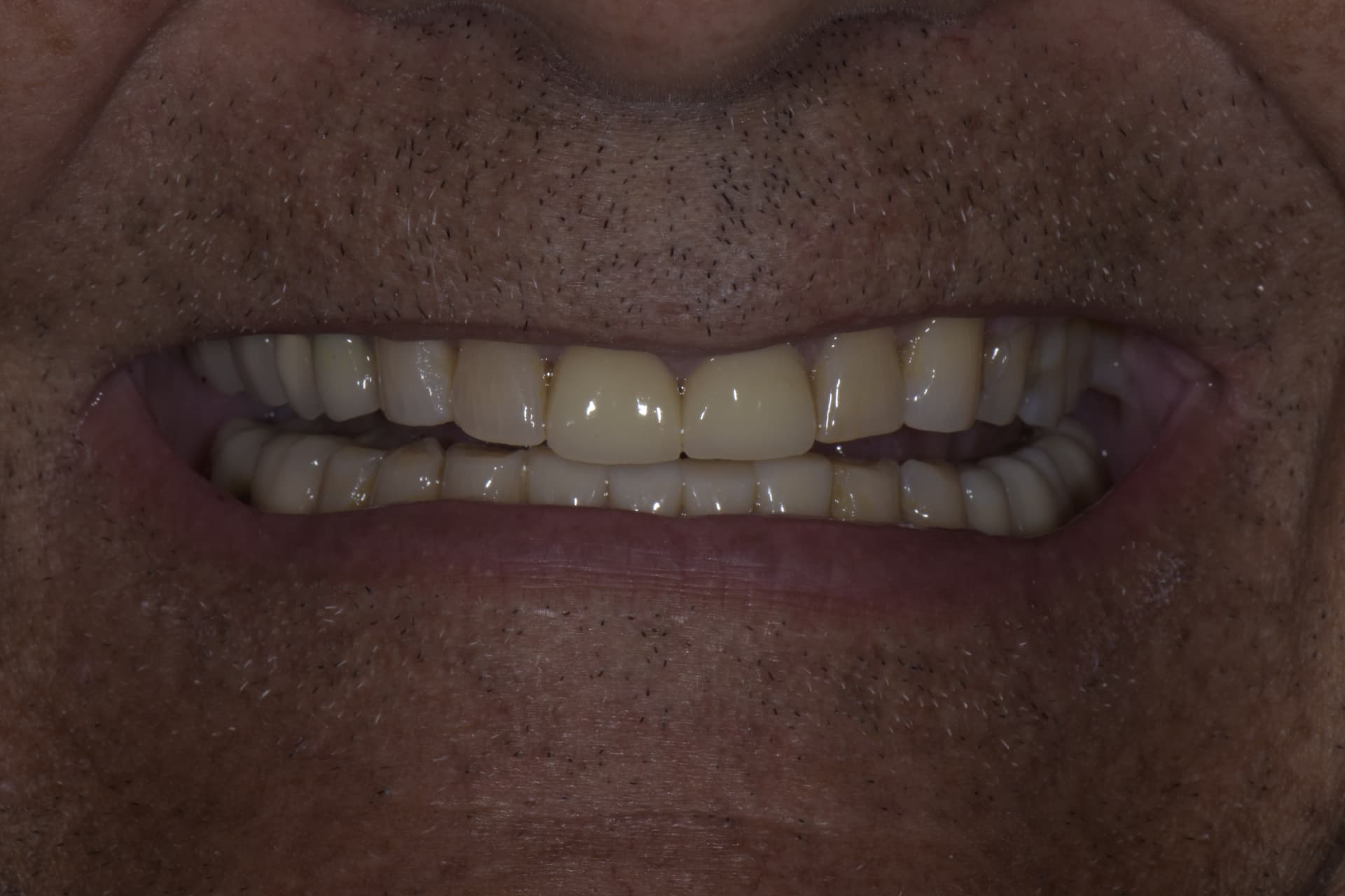 Smile before veneers, patient 3